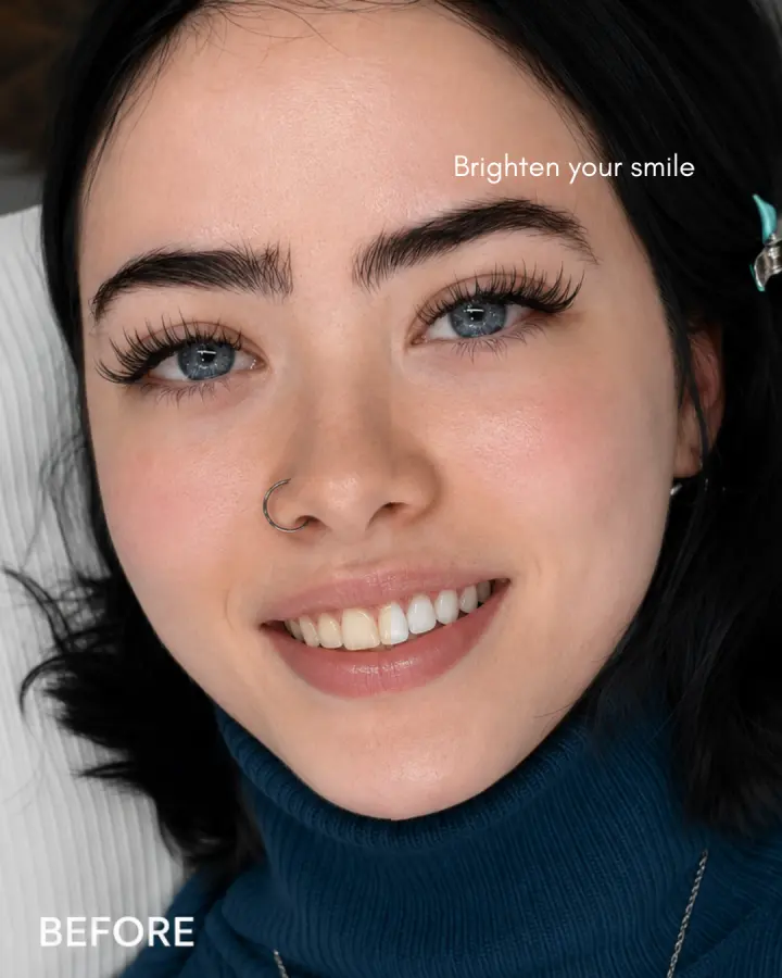 Mikado Aesthetics teeth whitening result